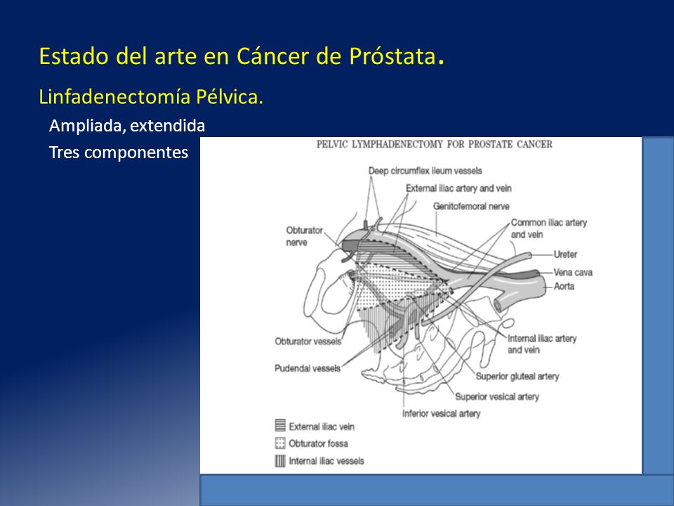 fotografía de próstata ampliada fotografía de próstata ampliada